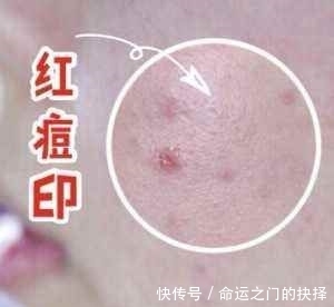 宿系■长年痘印也不怕——认清痘印类型,宿系之源还你光滑肌