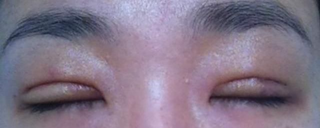  『影响』双眼皮术后恢复时间受哪些因素影响