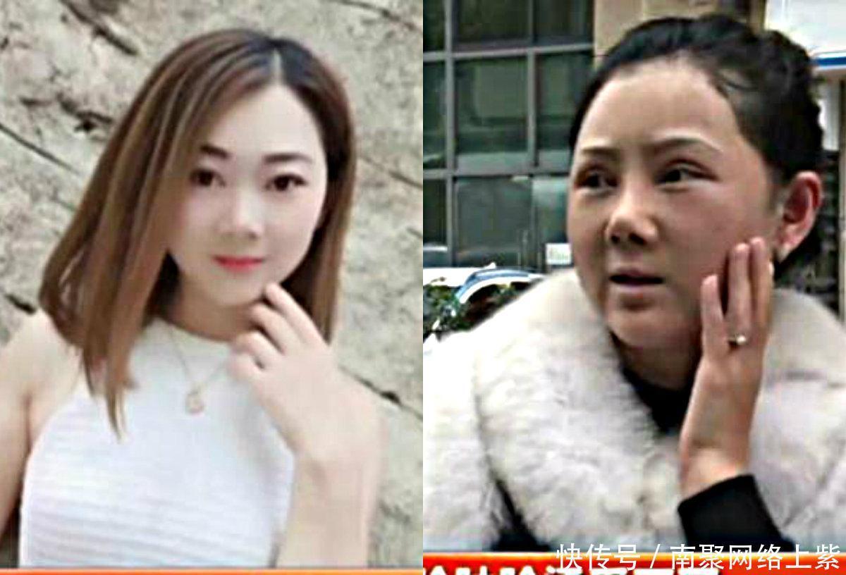  『漂亮』女子花9万元整容, 却脸肿脸烫的受不了, 如今完全像50岁大妈