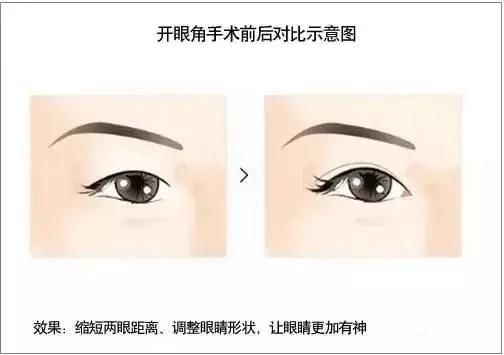  济南@想做双眼皮？先了解这8大误区！济南艺星第五季美杜莎女郎征集中