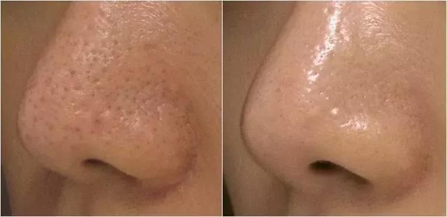 草莓鼻必看！一喷一抹，轻松把黑头分解掉！