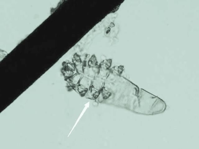 毛孔粗黑头多,示意螨虫“车载斗量”, 支配3妙招,一举歼灭螨虫