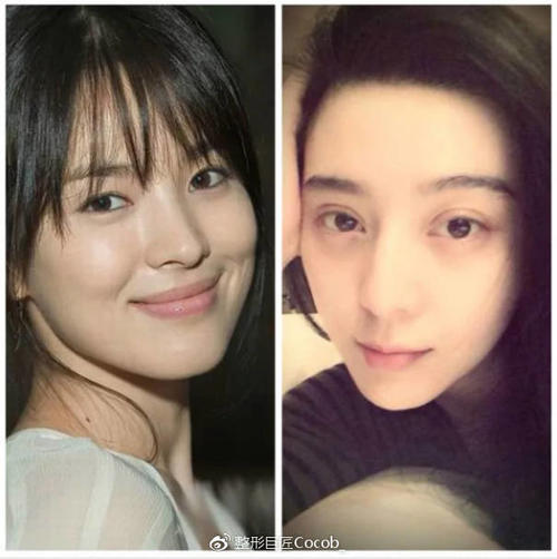 平行和扇形双眼皮该怎么选择？哪个更流行？