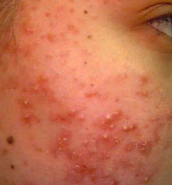 早起脸上3表现，每晚几万条螨虫在你脸上爬，逼走杀光它只需2招