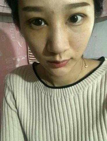 切开双眼皮真实案例分享，眼睛变大变有神了