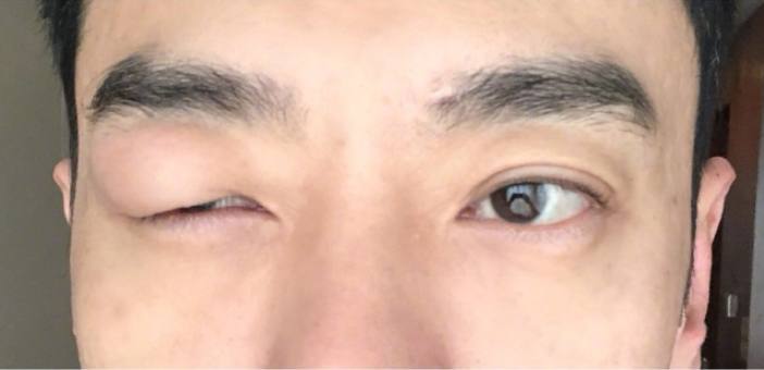 男星被蚊子叮咬后整个剧组停工，这蚊子是变异了吗？