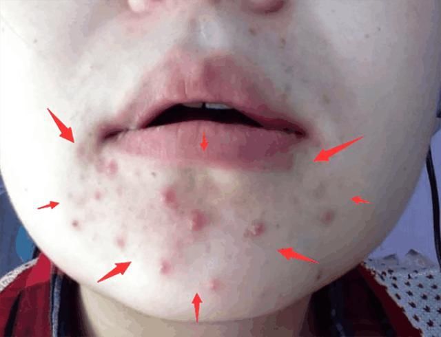 皮肤变成螨虫窝竟浑然不知，3方法教你自检，十试九中2招根除