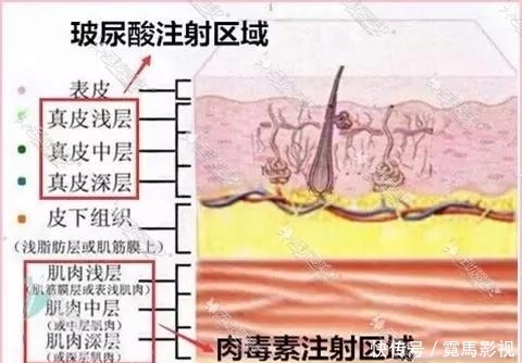 『除皱原理』玻尿酸解决静态皱纹,肉毒素对付动态皱纹,你适合哪个?