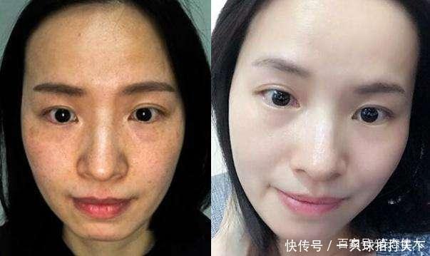 『恢复』皮肤有痘有色斑,赶紧把“花椒”用起来,15天便可恢复肌肤白净!