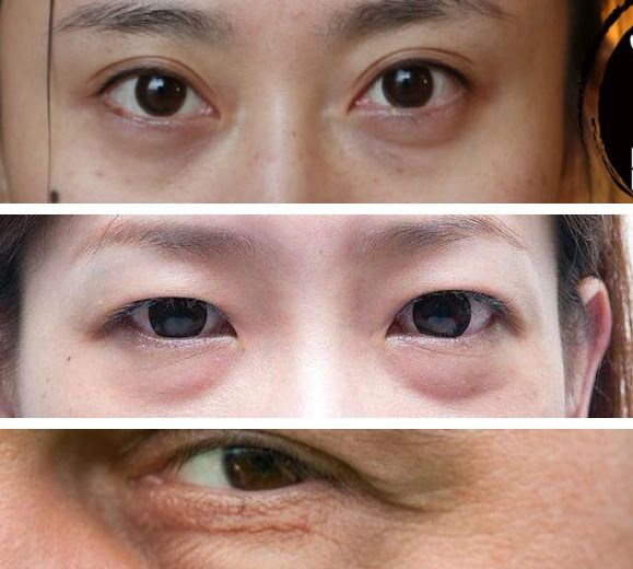 「衰老问题」素人整形分析 | 做对这些,宽方脸比瓜子脸更有优势
