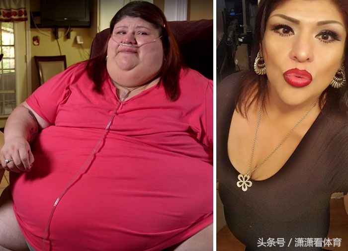 这群体重超过500斤的人仍回归正常，减肥堪比整容!