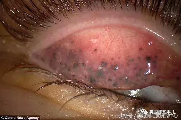 25年不卸妆!女子眼里长结石险失明