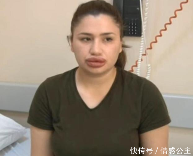 美女为了拥有性感迷人的嘴唇，去做了丰唇手术，手术后她却崩溃了