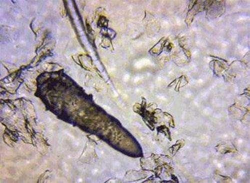 毛孔粗大冒油，还挤出小颗粒，别大意，多半是螨虫死死的堵毛孔里