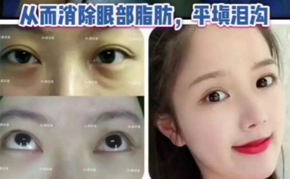  [熬夜]明明说好一起熬夜的，为什么就只有你熬出了眼袋+黑眼圈？