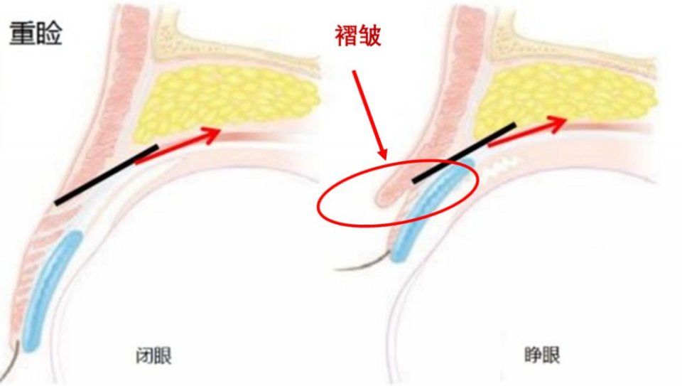 双眼皮“黄金不败宽度”来了!某璐要是早看到也不至于割完眼皮又