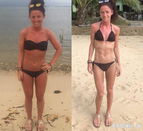 女子为减肥在手臂注射避孕药，最后却患上了厌食症，瘦的皮包骨头