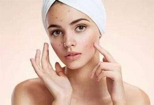 毛孔粗大冒油，还挤出小颗粒，别大意，多半是螨虫死死的堵毛孔里