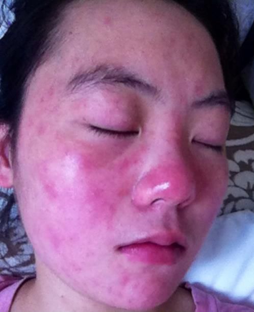 3种现像证明你脸上长螨虫，支你一个小妙招，螨虫死光光！