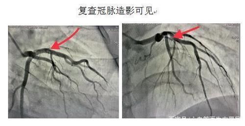  「送医」青年人突发心梗送医，医生揭秘，这是一种特殊类型的心梗