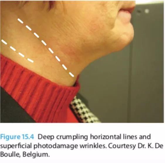 颈纹咋这么显老?别怪我没提醒，再晚就来不及了