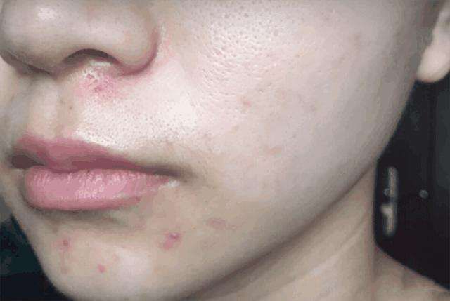 说实话:螨虫超出这个数,4个危害步步紧逼,再不除螨,脸要毁掉