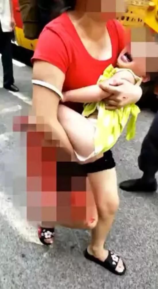 别再转发!南昌廖家3岁女孩被狗咬断腿,证实是谣言!