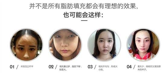 韦元强:女人面部凹陷为什么会显老?