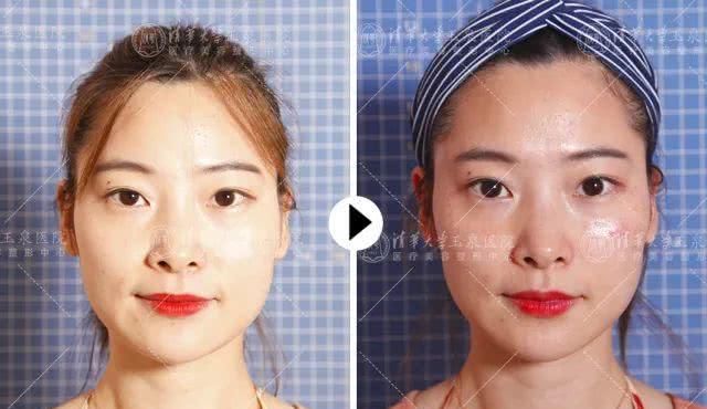  「填充苹果肌」看起来显老，问题可能出在苹果肌