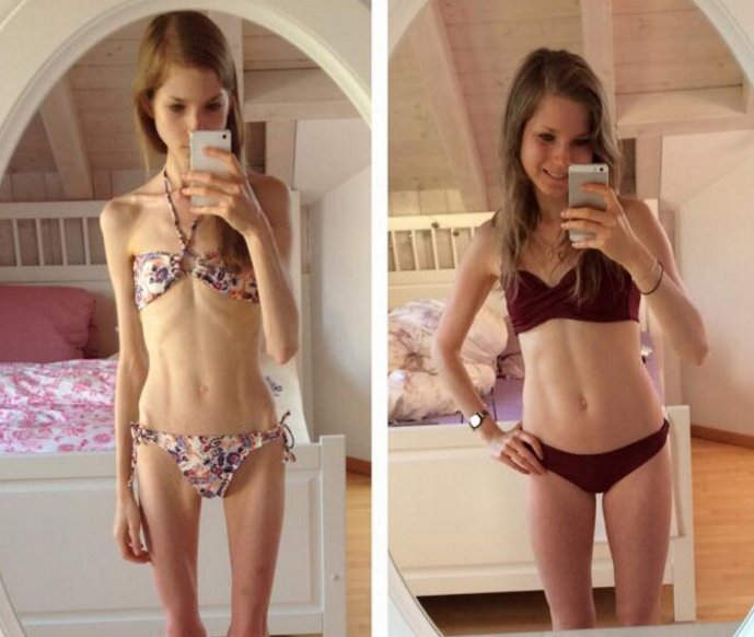 漂亮女孩天天节食最后瘦到只有40斤，为帅气男朋友增肥后变成女神