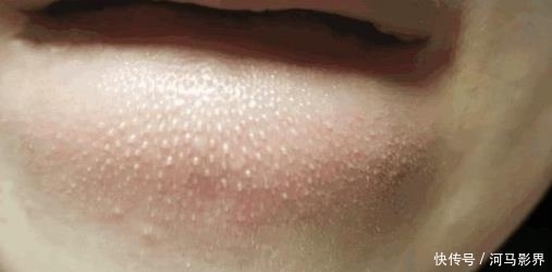 水油平衡■抿紧下巴后突起的“白疙瘩”,千万要注意,这是螨虫的真身吗