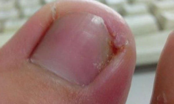  重度的嵌甲@脚趾甲总往肉里长，一碰还疼？关于“嵌甲”的3个原因，你要知道