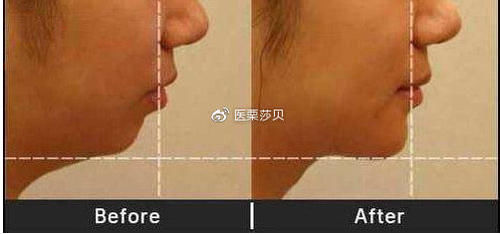  下巴手术：假体垫下巴能长期保持吗
