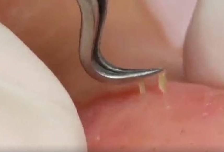 鼻子上挤出来的东西，分好几种，你知道几种呢?