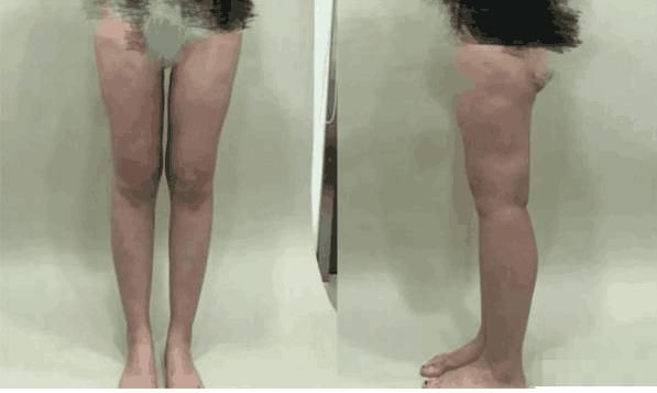 女子腿上全是坑，夏季不敢穿短裤出门 竟是爱美惹的祸