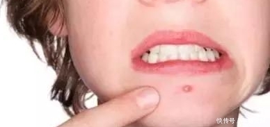 祛痘@最有效的祛痘方法,帮你5天祛痘10天淡化痘印!