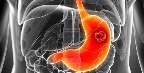 它们是慢性胃炎的“救星”，修复胃黏膜，远离幽门螺旋杆菌