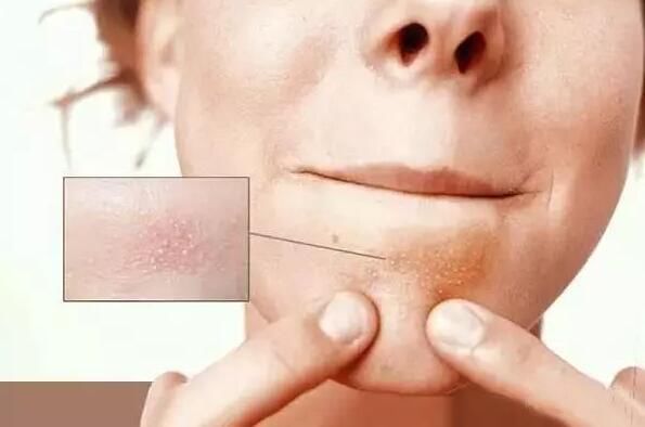 螨虫被称为“隐形杀手” 多用这2物，上万螨虫有去无回!