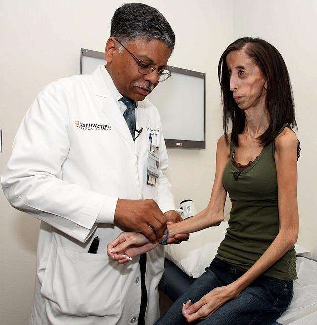 “零脂肪”的患病女孩，身高1米57，体重27公斤