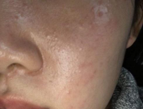 脸上发黄有痘痘？是螨虫在纠缠，每天需一法，螨虫轻松消失干净