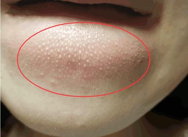 下巴紧绷后凸起的“白色米粒”，竟让我不敢抬头，清退只需2招