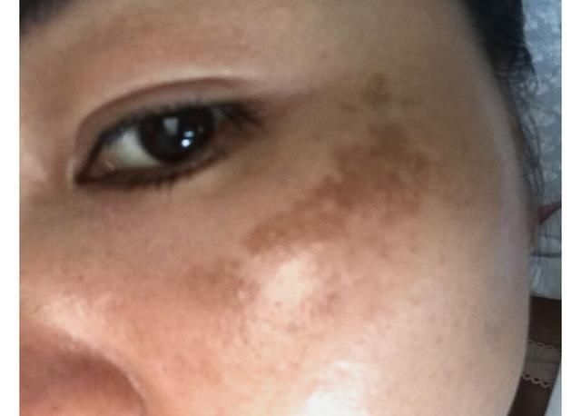 黄褐斑在脸上扎堆怎么办？用对这2招，轻松下斑脸蛋白净