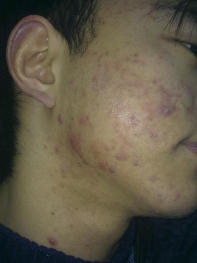 冒出“老年斑”不用害怕，教你1个土法，抹5次斑如雨下