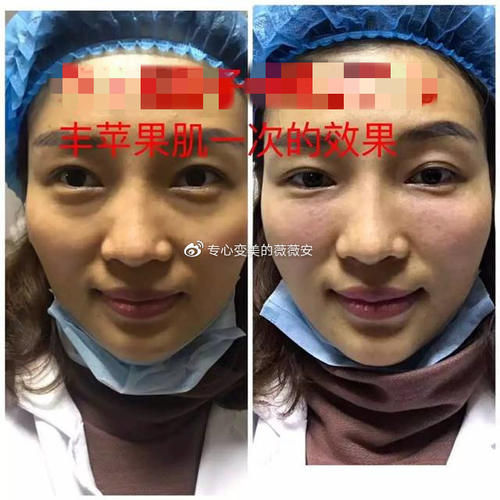  求美者来说■“苹果肌”打造全攻略！