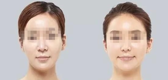  「颧弓」面部轮廓整形之“颧骨颧弓”