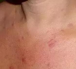 开口闭口粉刺,识别黑头白头……了解这些你冒痘的脸还有得救!