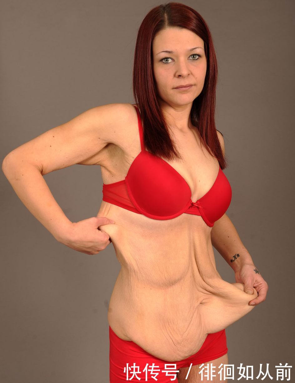 39岁女子一年减掉120斤，如今留下“尴尬”身体希望胖回去