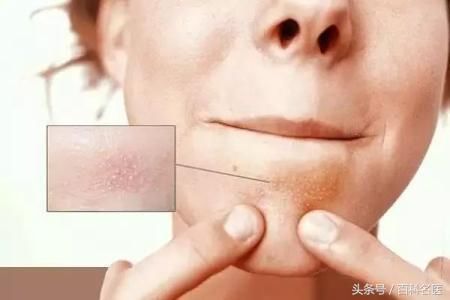 下巴紧绷后的白色颗粒到底是什么？