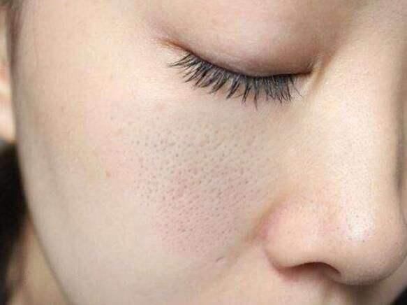 脸上这4个异常，说明已经感染螨虫，再不除螨，脸注定是负担