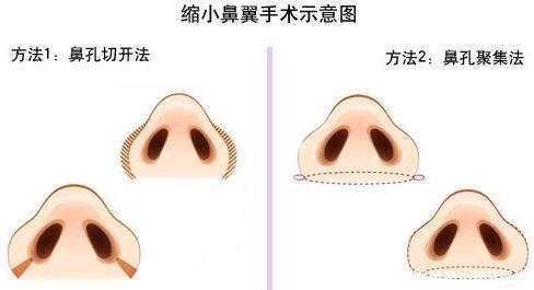 『鼻翼』鼻翼缩小手术会留疤吗